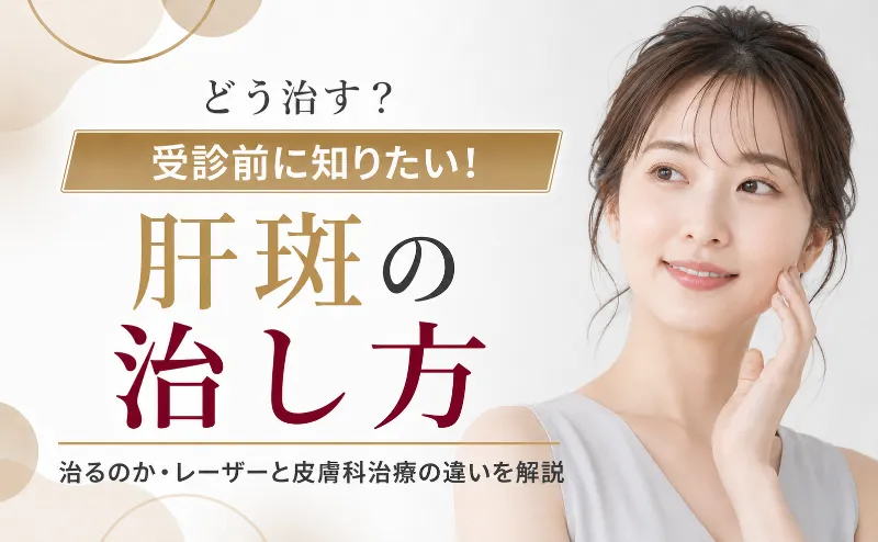 肝斑の治し方が分かる！治るのかレーザーと皮膚科治療の違い
